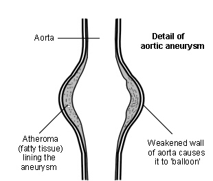 Abdominal Aorta Definition